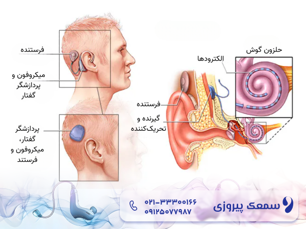 کاشت حلزون برای ناشنوایی مادرزادی